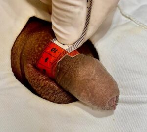 Depois do engrossamento com 40 ml de AH: 13,3 cm. Pênis longo com 15 cm e prepúcio redundante tem que colocar mais AH.