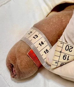 Depois do engrossamento com 40 ml de AH: 13,3 cm. Pênis longo com 15 cm e prepúcio redundante tem que colocar mais AH.