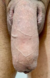 Com 24 horas o pênis está mais grosso porque o AH puxa água.