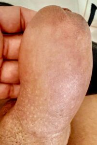 Com 24 horas o pênis está mais grosso porque o AH puxa água.