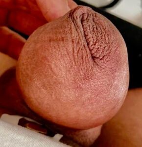 Com 48 já quase com o mesmo diâmetro que ficou após o procedimento mas ainda inchado.