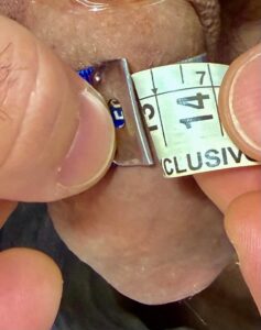 12,8 cm no primeiro dia após aplicação