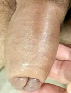 Quarto dia com edema na ponta da pele devido ao efeito da gravidade. Acometimento normal no p3nis com muita pele (prepúcio redundante). Edema transitório.