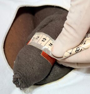 Imediatamente após aplicação de 30 ml de AH: 13,2 cm