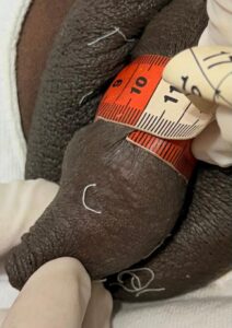 Diâmetro antes do procedimento: 10 cm