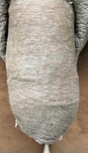 48 horas após o AH já está bem ditribuido quase uniformemente