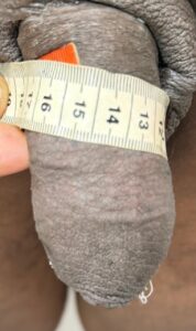 24 horas após aplicação: 14,5 cm. Pênis incha porque o AH puxa água!